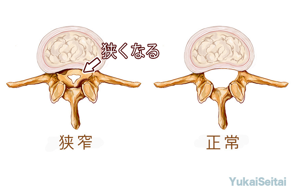 腰椎の脊柱管狭窄の状態