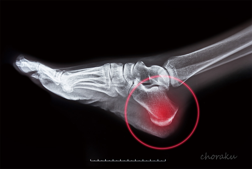 かかとが痛い踵骨骨端症(シーバー病、セーバー病)のレントゲン写真
