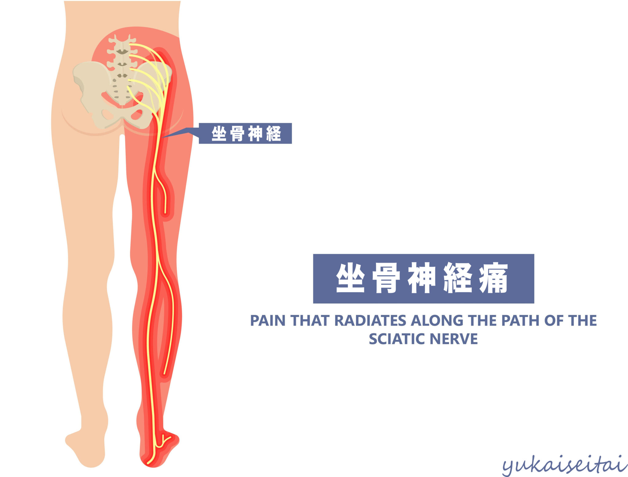 坐骨神経痛の痛みを軽減するために冷温を使用する
