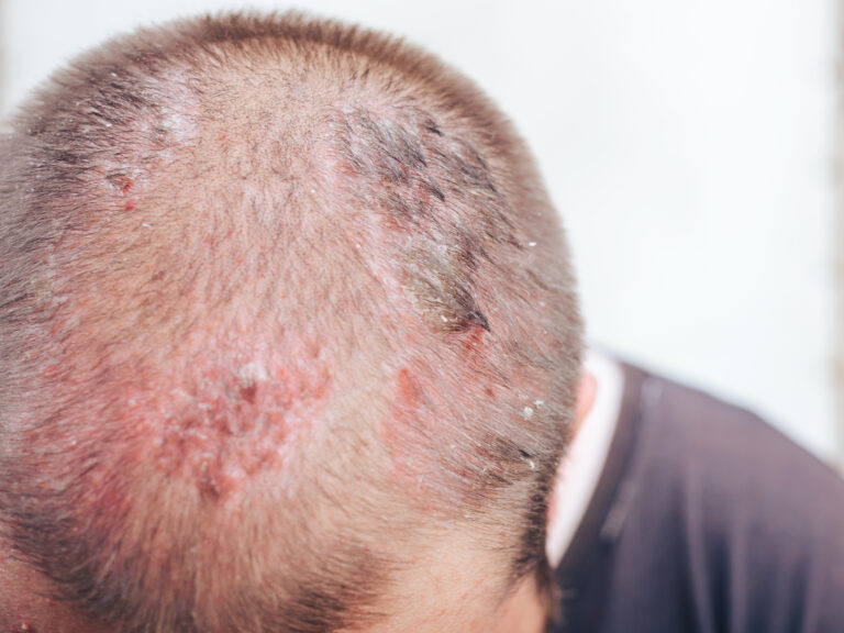 頭皮に帯状疱疹ができる原因は何ですか?